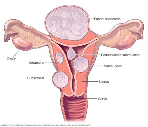 Types Of Uterine Fibroids Best Treatment For Fibroids In Trivandrum