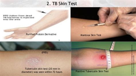 They'll inject a tiny amount of fluid called tuberculin just below the skin in. How do we test for whether a person has Tuberculosis or ...