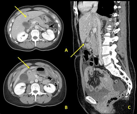A Case Of Acute Abdominal Pain Due To Duodenal Perforation Serau