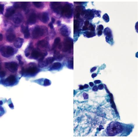 Cytomorphology Of Lung Adenocarcinoma Adc In Thinprep Bronchial