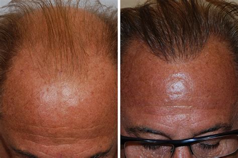 Hair Restoration 8 David Rosenberg Md Pllc