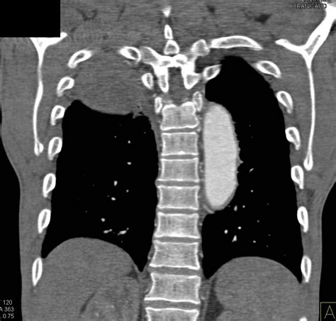 Lung Cancer Nsclc Encases The Right Upper Lobe Bronchus With Apical