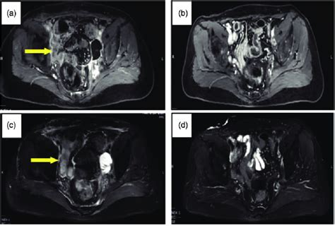 Magnetic Resonance Imaging Mri Before And After Chemotherapy Combined