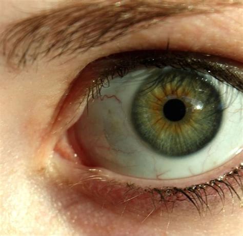 why do some people have dark rings around the iris of their eye bellatory