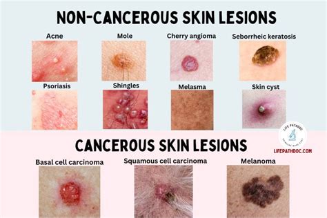 Skin Lesions Types With Chart Pictures Causes Treatment