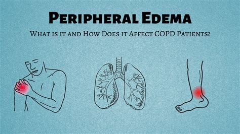 What Is Peripheral Edema And Why Is It A Concern For Copd Patients