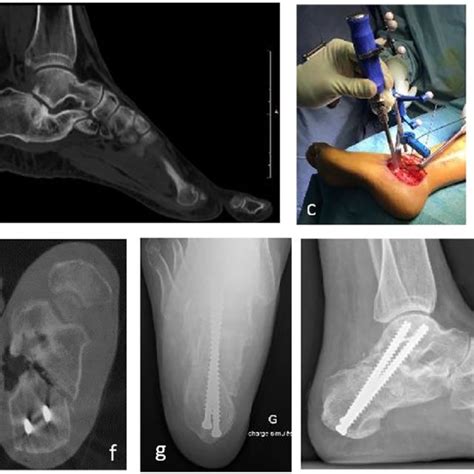 Calcaneus Malunion Osteotomy Through The Primary Fracture Line And