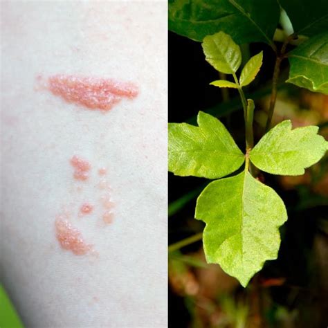 Poison Oak Rash Symptoms Soothing Natural Treatments Dr Axe