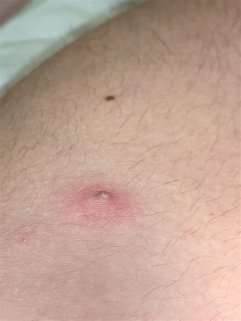 What Is This Bump On My Arm Have Had A Small Grey Spot In This Spot