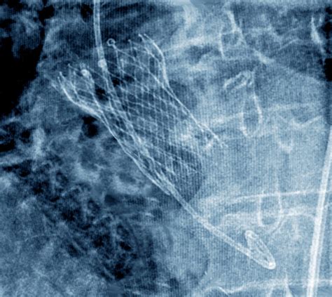 Prosthetic Aortic Valve X Ray Bild Kaufen 13600030 Science Photo