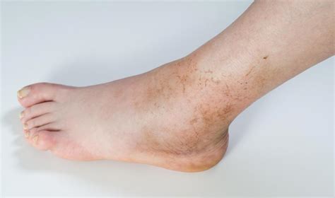 Ankle Pain Symptoms Causes And Treatment Stdgov Blog