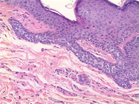 Histopatologando Atlas Do Hcfmrp Usp Tumor Do Infundíbulo Folicular