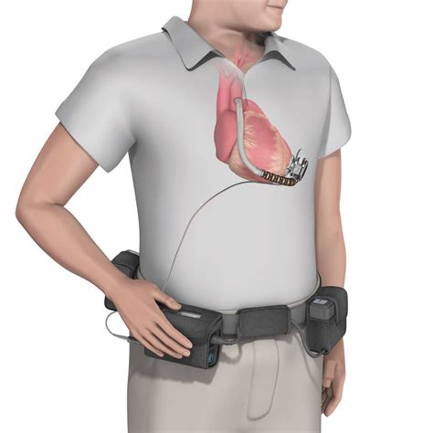 Schematic Of A Left Ventricular Assist Device Lvad In Situ With