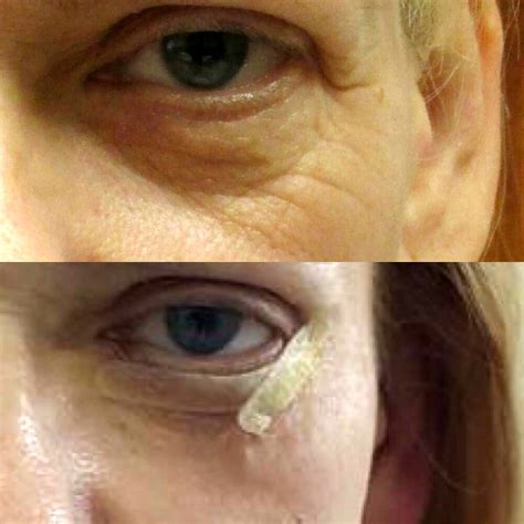 Get Laser Eyelid Surgery To Remove Bags Under Eyes Eyelid Surgery