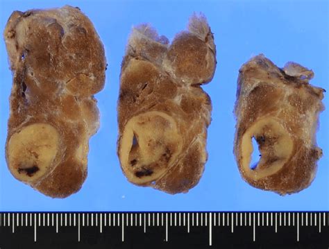 Gross Appearance Of The Thyroid Tumor Cut Surface After Formalin