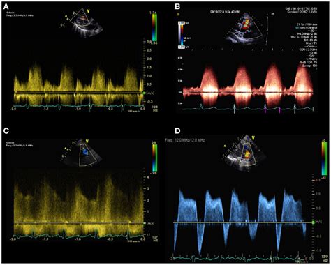 Can hypoxemia develop in a *left to right shunt or a right to left shunt? Frontiers | Echocardiography in Pediatric Pulmonary ...