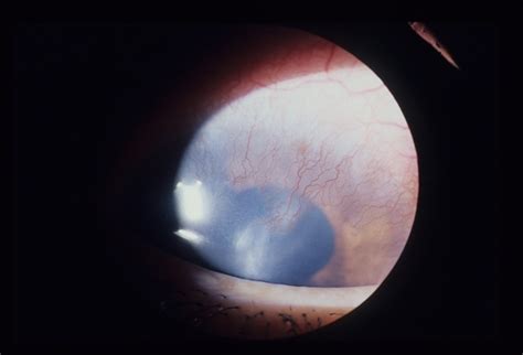 Acne Rosacea Phlyctenular Keratitis Retina Image Bank