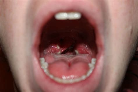 How Do I Get Rid Of These White Puss Things On My Tonsils Health