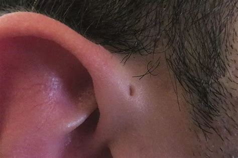 Some People Are Born With Tiny Holes Above Their Ears Heres Why