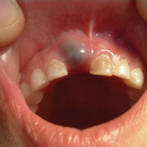 Eruption Cysts Causes Symptoms And Treatments