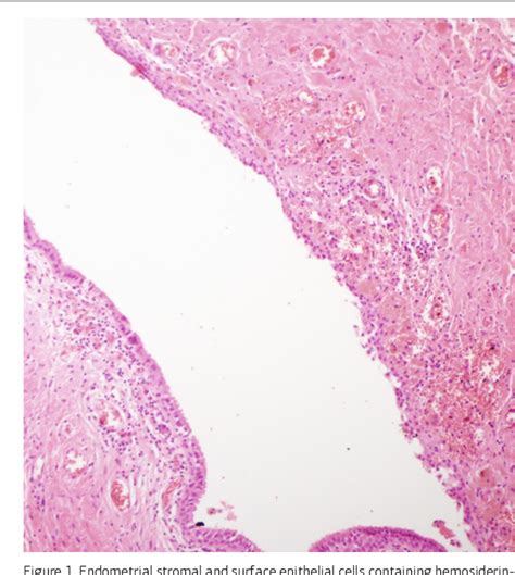 Figure 1 From Postmenopausal Vaginal Endometriotic Cyst A Case Report