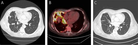 Treatment Response In A 61 Year Old Male Patient With Malignant Pleural