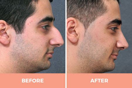 When preparing for a nose job before and after, patients should obtain cost information from their surgeons and discuss with their. Male Rhinoplasty Sydney By Renowned Facial Plastic Surgeon ...