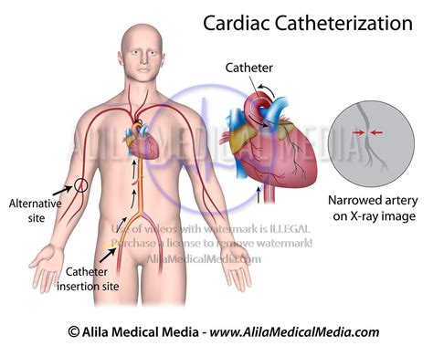 alila medical media cardiac catheterization medical illustration