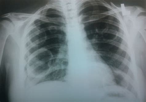 Chest X Ray Showing Three Cavities In Right Lobe And Three Cavities In