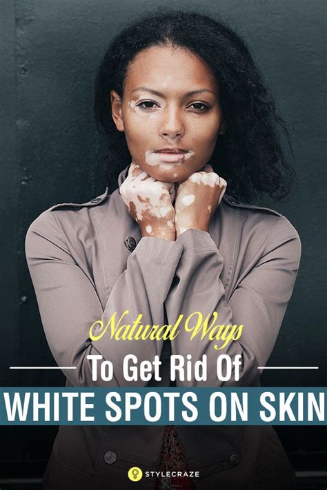 White Spots On Skin Vitiligo Causes Symptoms And Remedies Skin