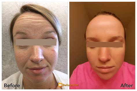 Amazing Results With Vampire Facelift This Is An Actual Patient Botoxbeforeandafter