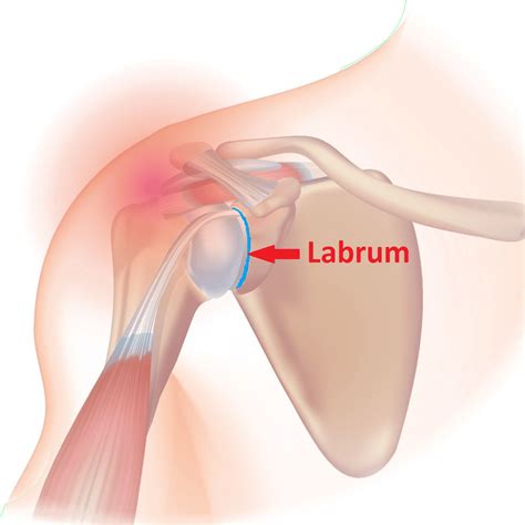 Labral Tear In Shoulder Symptoms Treatment Exercises