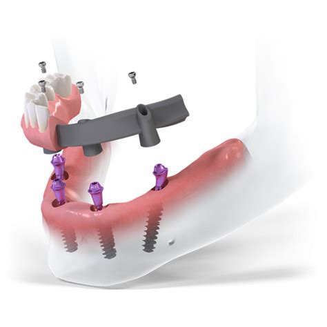 Straumann® Dental Implants - BK DENTAL