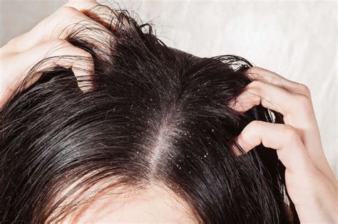 Tackle Hair Loss Head On 3 Scalp Conditions Unveiled Zang Smp