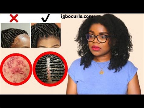 How To Prevent Heal Bumps From Braided Hair Igbocurls