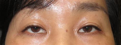 severe congenital ptosis in the asian upper eyelid