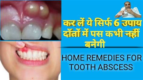 Top 6 Home Remedies For Tooth Abscess Home Remedy For Tooth Abscess
