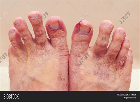 Wounds On Big Toe Image And Photo Free Trial Bigstock