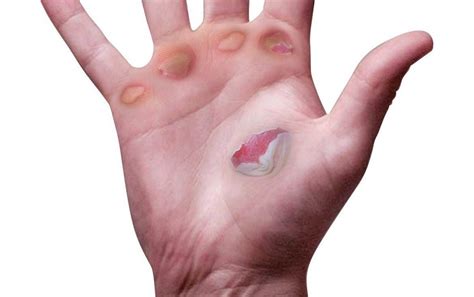 How To Treat Blisters On Hands Properly And Promptly