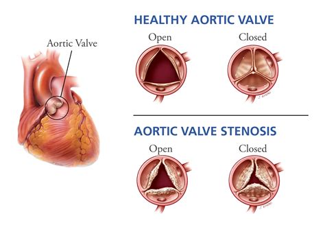 Aortic Valve Stenosis Chart