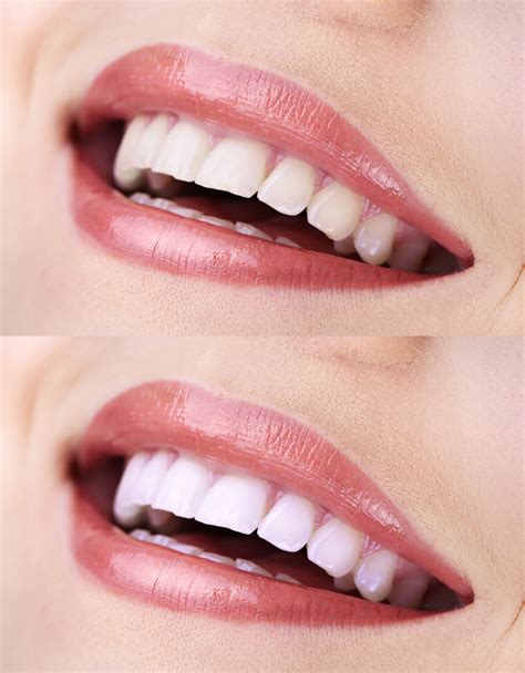 Dentist Office Types Of Teeth Whitening Treatments