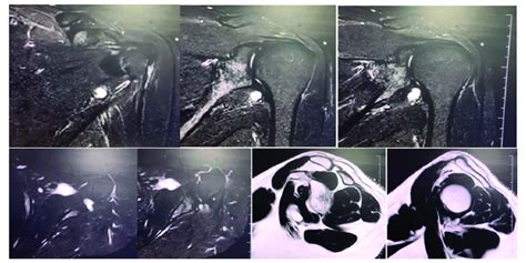 Magnetic Resonance Imaging Pictures Showing Paralabral Cyst At