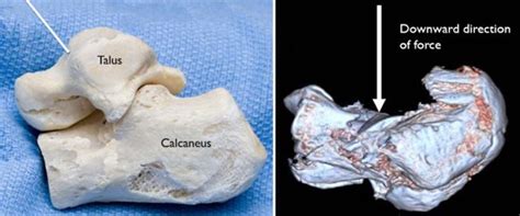 Calcaneus Heel Bone Fractures OrthoInfo AAOS