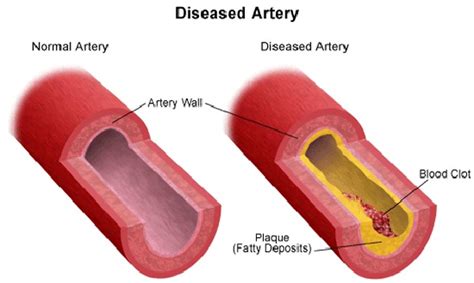 Vascular Disease Causes Stanford Health Care