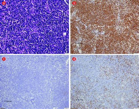 A Hematoxylin And Eosin Staining Revealed Atypical Lymphoid Cells Of