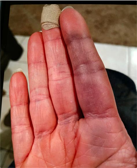 Achenbach Syndrome In A Patient With Raynauds Phenomenon The