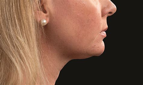 Coolsculpting Double Chin Cost Treatment Results Nyc