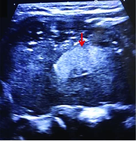 Ultrasound US Images Of A 25 Year Old Woman With A Mature Cystic