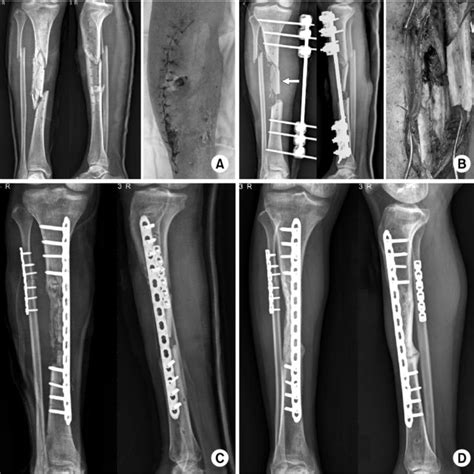 A 62 Year Old Male With An Open Comminuted Fracture Showing A Segmental