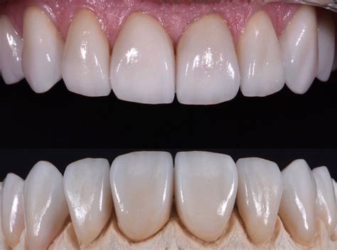 Porcelain Veneers Specialist 02 Los Angeles Dentist Porcelain Veneers Specialist